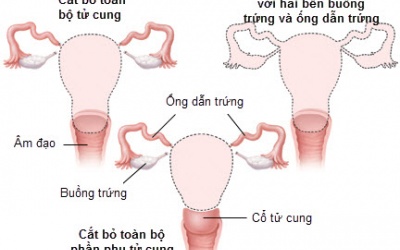 Cắt bỏ tử cung và buồng trứng có gây mệt mỏi, đau nhức xương?