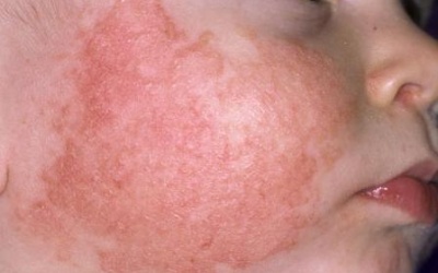 Giao mùa, đề phòng một số bệnh về da