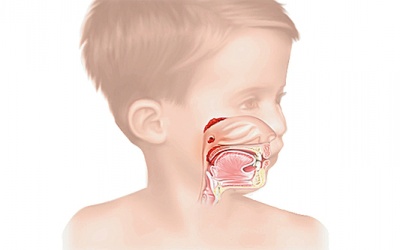 Viêm VA ở trẻ: Sớm không trị, muộn bị gù lưng, thấp khớp
