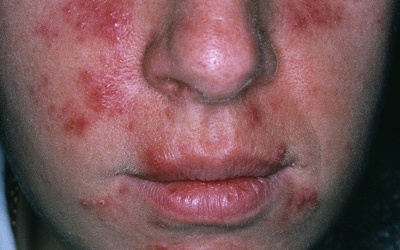 Trị bệnh mẩn đỏ có mủ rosacea như thế nào?