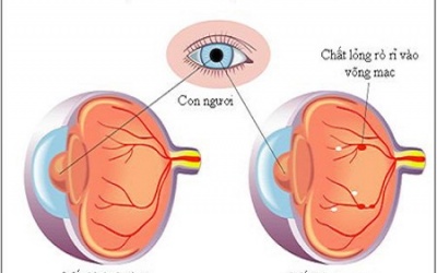 Video: Nguyên nhân nào gây mù lòa ở người đái tháo đường?