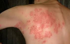 Có cần thiết tiêm phòng zona cho bệnh nhân lớn tuổi?