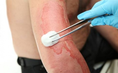 Video: Mẹo cấp cứu nhanh cho vùng da bị bỏng