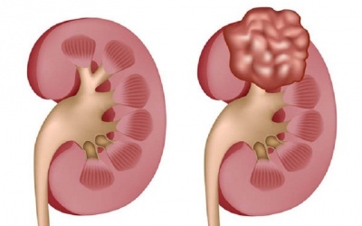 60 tuổi có nên mổ nội soi nang thận?