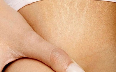 Đâu là nguyên nhân “gốc rễ” của rạn da sau sinh?