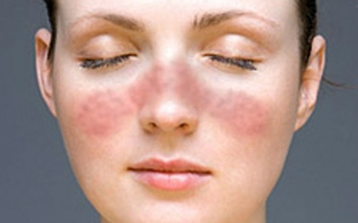 Kháng thể lupus trong máu có phải là dấu hiệu bị mắc bệnh lupus?