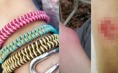 Hãi hùng với cổ tay mưng mủ do đeo vòng quá chật