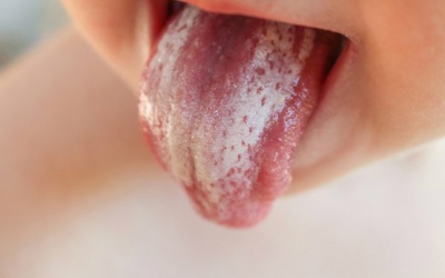 Nấm miệng, lưỡi trắng bợt dùng TPCN có ăn thua?