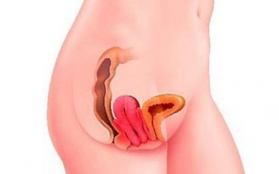 Viêm xương khớp có gây thoát vị âm đạo?