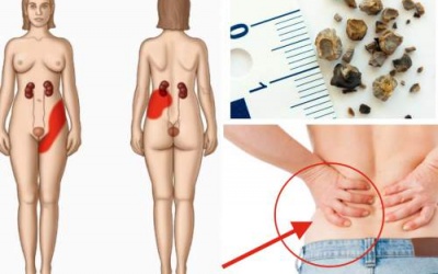 Thường xuyên buồn tiểu, vã mồ hôi: Coi chừng sỏi thận