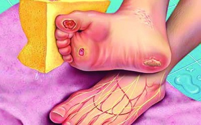 Video: Nguy cơ cắt cụt chân tay ở người đái tháo đường