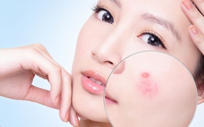 Trị mụn trứng cá bằng thuốc có nguy hiểm không?