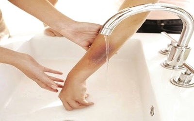 Có nên chườm đá lạnh, bôi kem đánh răng khi bị bỏng?