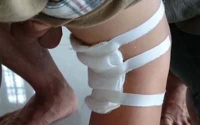 U nang khoeo là bệnh gì?