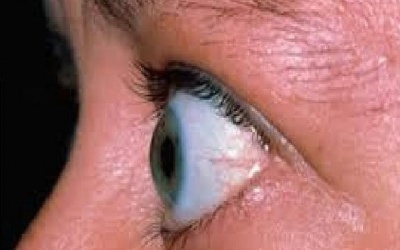 Chữa lồi mắt do bệnh cường tuyến giáp Basedow