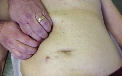 Hội chứng viêm sụn sườn điều trị như thế nào?