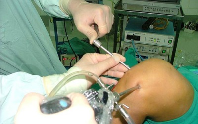 Bệnh nhân nghèo được thay khớp miễn phí