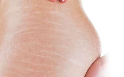 Bạn có biết: 6 sự thật đáng ngạc nhiên về rạn da