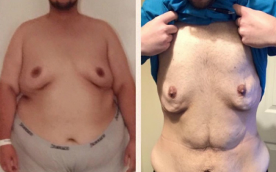 Chàng trai chi 15.000 bảng Anh cắt da thừa sau khi giảm 100kg