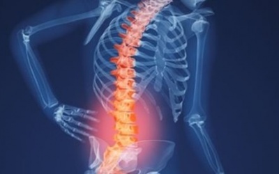 Lần đầu tiên phẫu thuật thay thân đốt sống nhân tạo