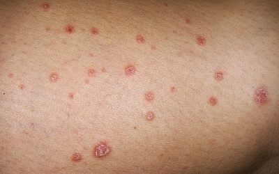 Viêm da cơ địa dị ứng có dùng kem thảo dược hay thực phẩm chức năng được không?