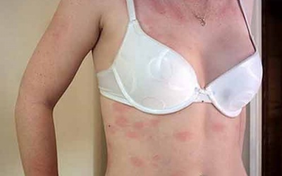 Cách điều trị bệnh mề day dứt điểm