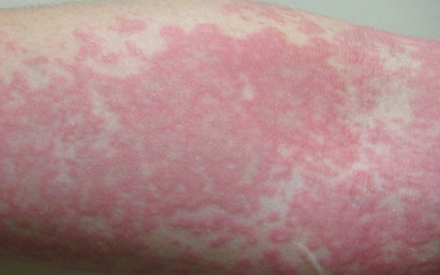 Sự khác biệt của bệnh nổi mề đay và phát ban nhiệt