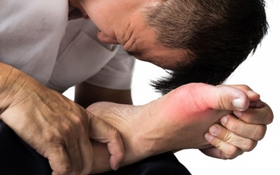 Bệnh gout làm tăng nguy cơ rung nhĩ