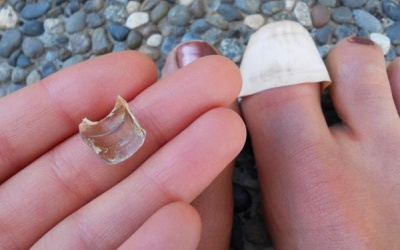 Móng chân bị bong liệu có mọc lại?