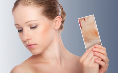 Có hay không chuyện dầu dừa trị mụn trứng cá?