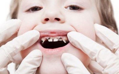 Cha mẹ cần làm gì khi răng của trẻ bị sâu?