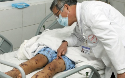 Hà Nội ghi nhận ca viêm não mô cầu đầu tiên