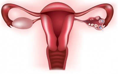 Suy buồng trứng – Bản án vô sinh nhưng vẫn có con được