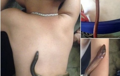 Có nên hạ sốt cho trẻ bằng lươn sống?