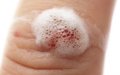 Tại sao không nên dùng nước oxy già để rửa vết thương?