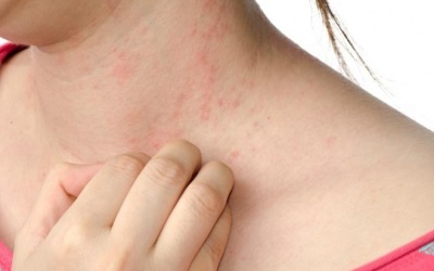 Ngứa da sau khi tắm mùa Đông phải làm sao?