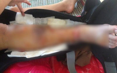 Xót xa cảnh nữ sinh mất chân vì bệnh viện tắc trách