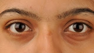 Khi “cửa sổ tâm hồn” bị ảnh hưởng bởi cường giáp