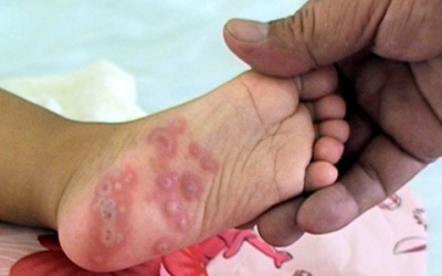 Không phân biệt được 2 bệnh này, mẹ dễ mất con!