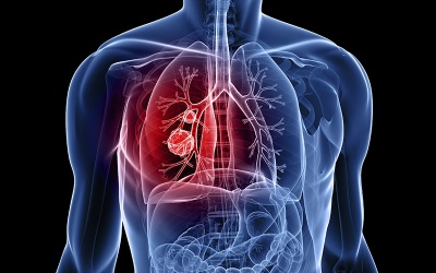 Thuốc mới trị bệnh ung thư phổi hiếm gặp