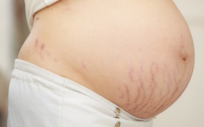 Đẩy lùi rạn da bằng cách nào?