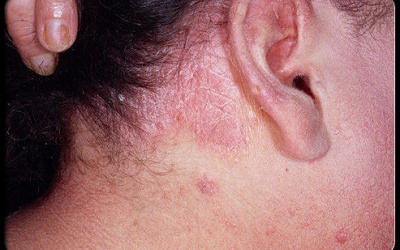 Mắc bệnh vẩy nến dễ bị loãng xương