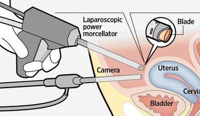 Phẫu thuật u xơ tử cung bằng morcellator có an toàn?