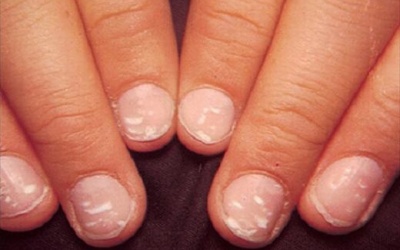 Móng tay có đốm trắng như hạt gạo là bệnh gì?