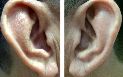 Nhìn dái tai đoán bệnh tim mạch