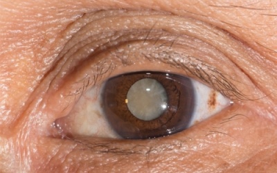 Vitamin C: Tăng khả năng phòng ngừa đục thủy tinh thể