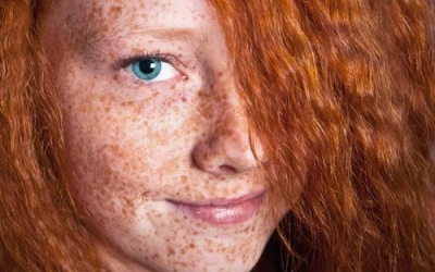 Bất ngờ từ việc điều trị nám da từ acid tranexamic