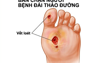 Dễ cụt tay chân vì biến chứng đái tháo đường