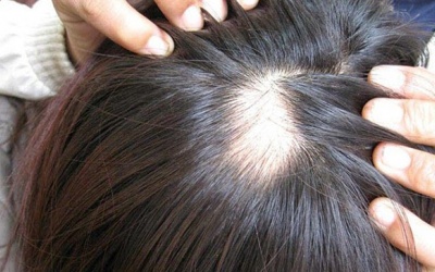 Nghiện nhổ tóc có thể là dấu hiệu của bệnh tâm thần