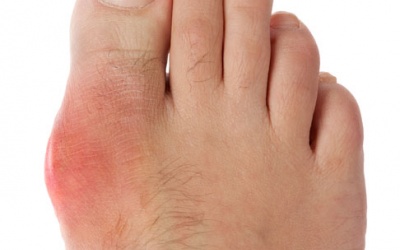 30 tuổi đã mắc gout phải làm thế nào?
